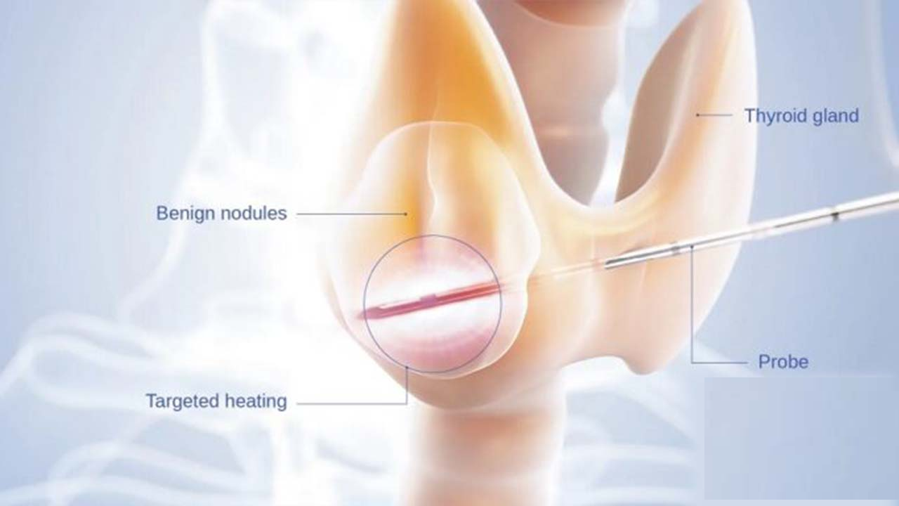 Radyofrekans ablasyon cihazının ucu